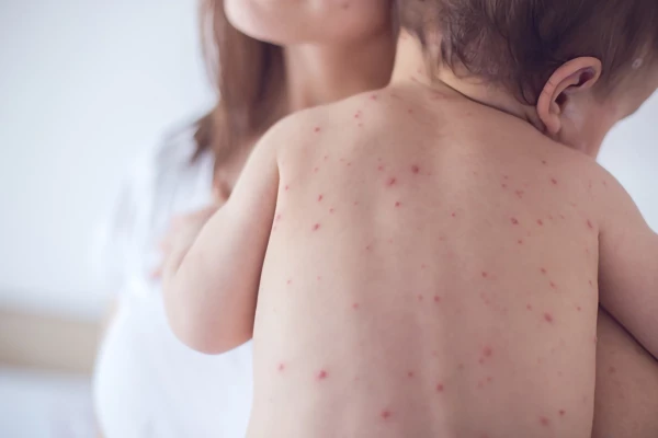 Image for article titled Measles - Do you know the symptoms?